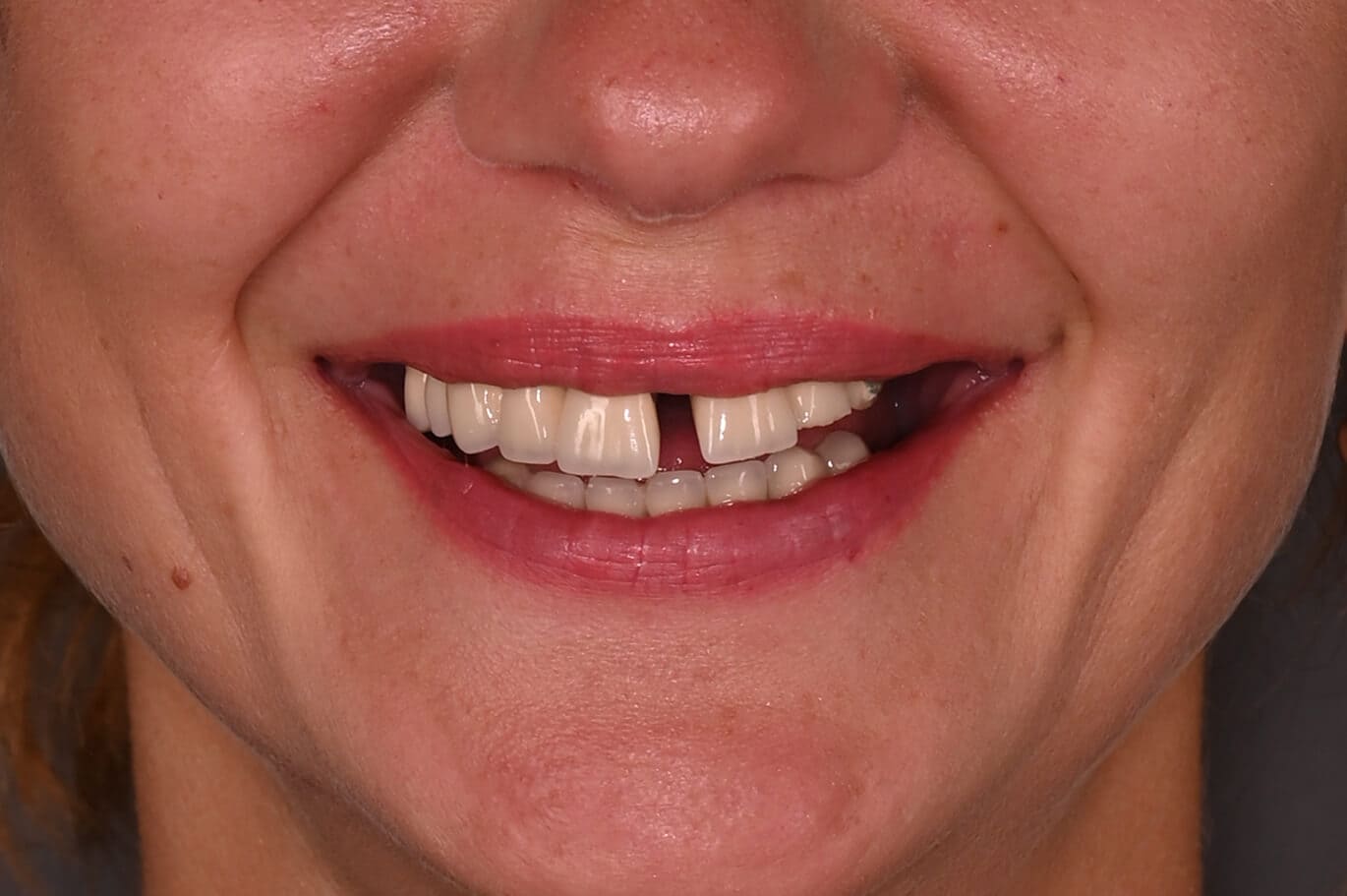 Pacient Clinica Dr. Alin Odor - Rezultat Implantologie